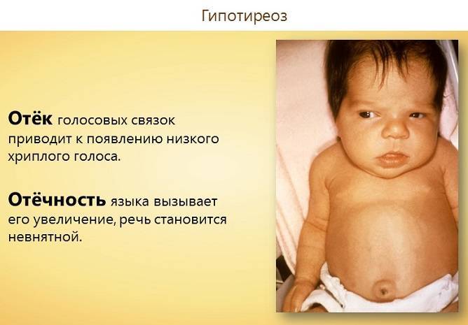 Гипотиреоз - виды, симптомы, последствия * клиника диана в санкт-петербурге
