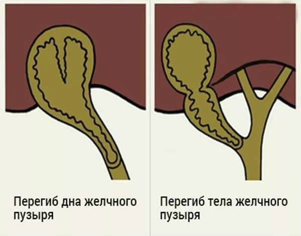 Острый панкреатит: особенности течения болезни, диета и лечение