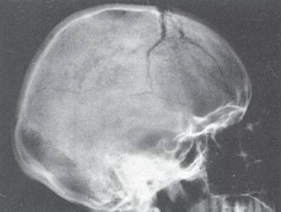Трещина черепа у ребенка. Перелом теменной кости черепа рентген. Вдавленный перелом свода черепа рентген. Перелом костей черепа рентген. Импрессионный перелом свода черепа.