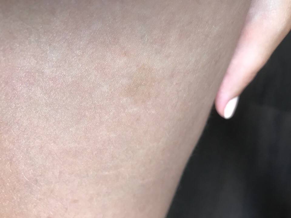 Сыпь на коже: как по высыпаниям определить, чем болеет человек