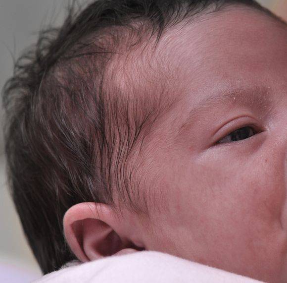 «щетинка» у новорожденного: признаки, причины появления и методы лечения