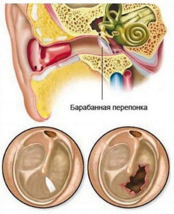 Отит у ребенка картинки