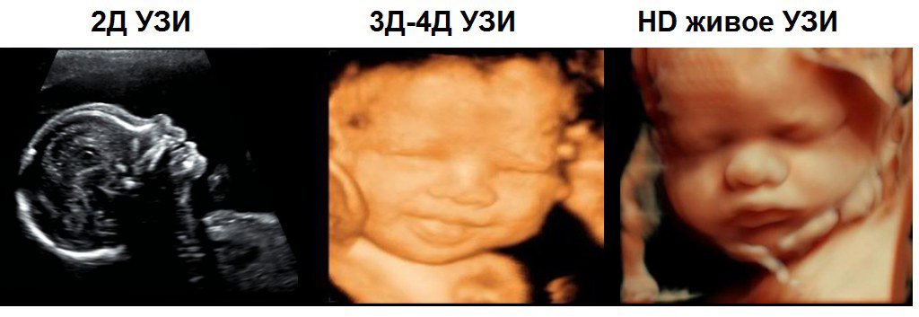 3d/4d ультразвуковое исследование при беременности