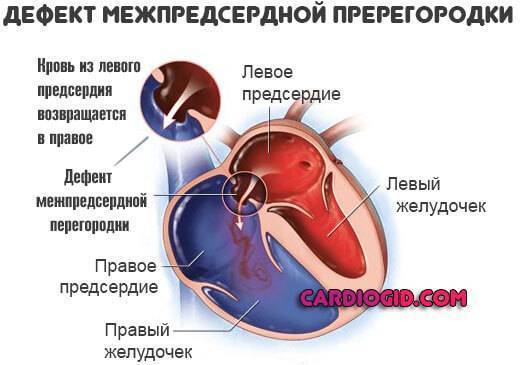 1 3 окно в сердце. Врожденный порок сердца открытое овальное окно. Незаращение овального окна в сердце. Порок сердца открытое овальное окно на ЭКГ. Врожденный порок сердца овальное окно.