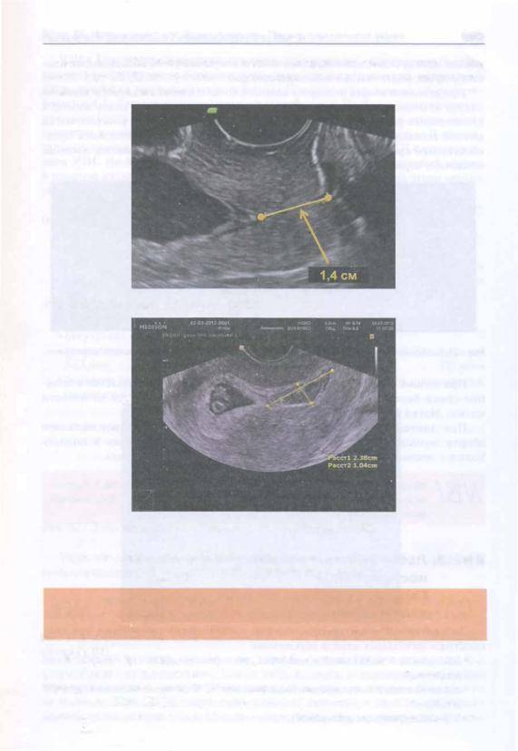 Узи шейки матки при беременности цервикометрия