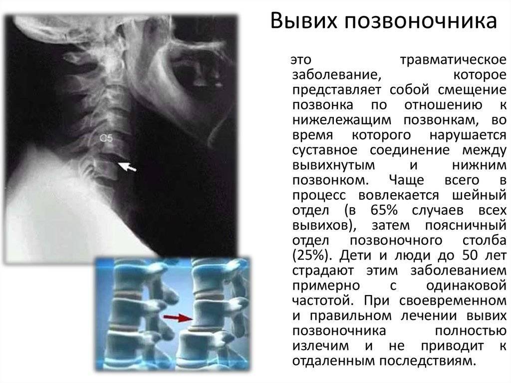 Листез — смещение позвонков