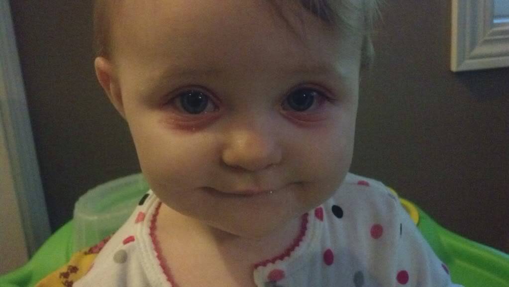 Почему у детей появляются синяки под глазами?