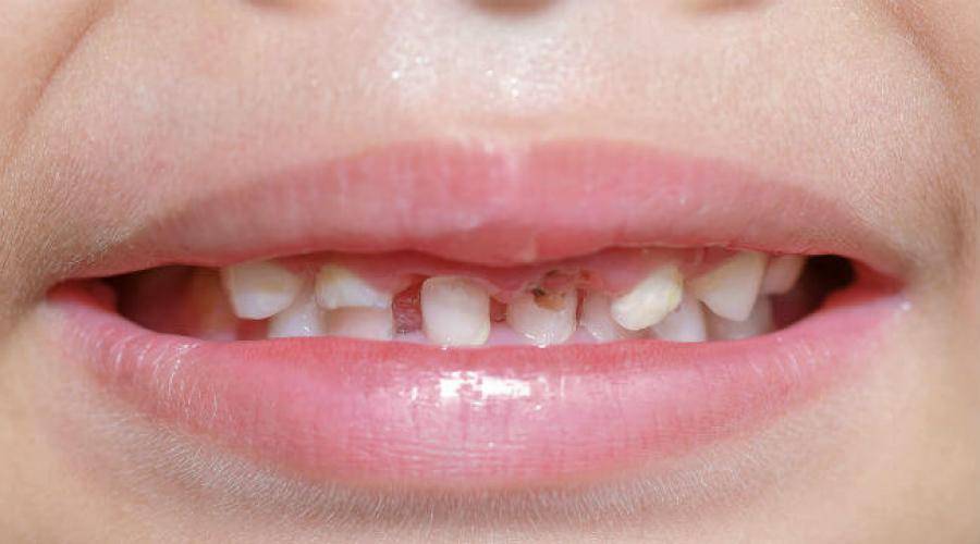 Темные делишки наших зубов: кариес