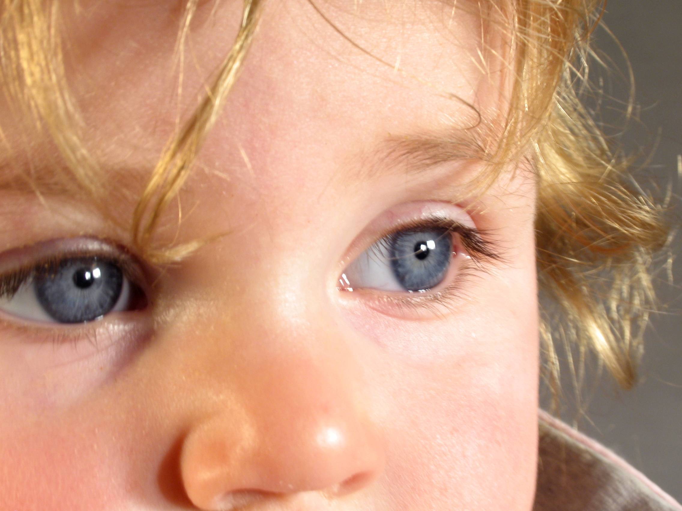 Ангиопатия сосудов сетчатки глаза у ребенка (в т.ч. у новорожденного) - причины и лечение