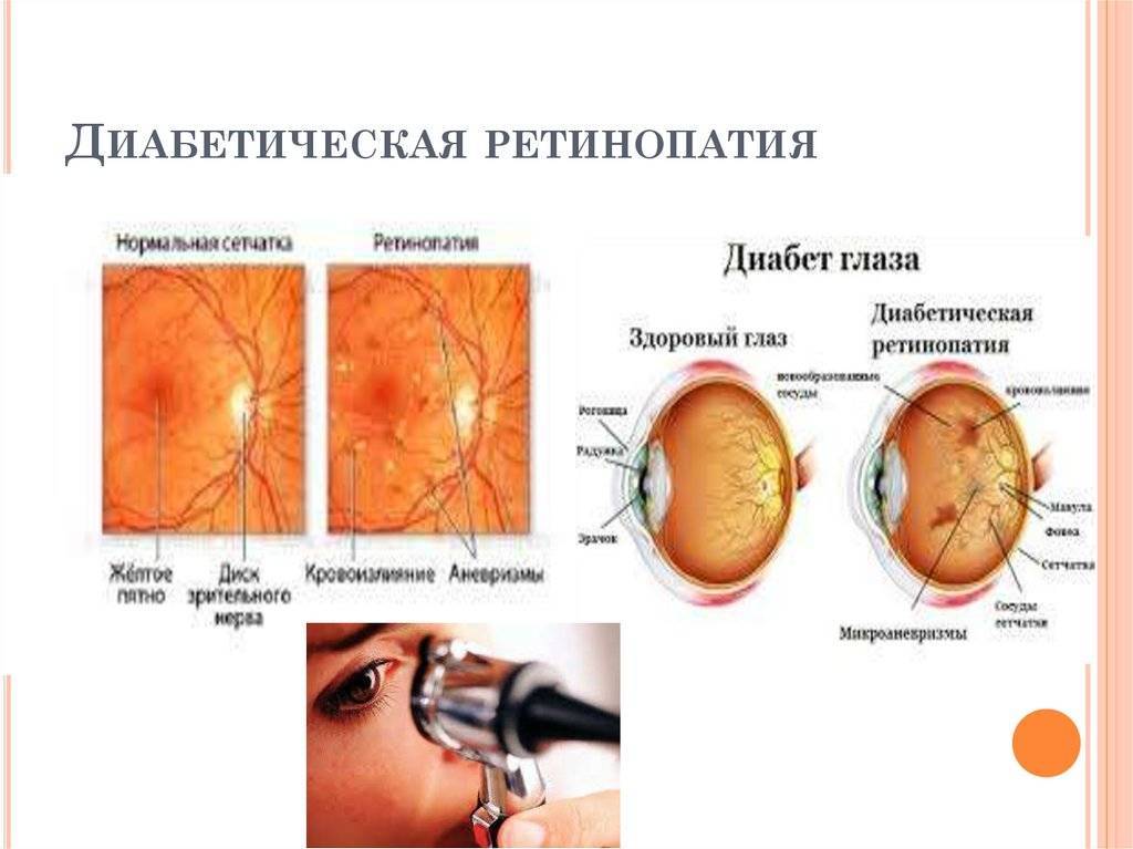 Ангиопатия сетчатки глаз