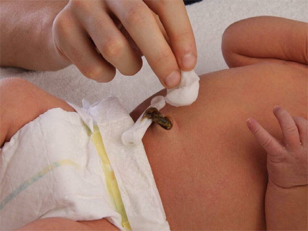 Фунгус пупка у новорожденных: фото, лечение гранулемы солью (совет комаровского)