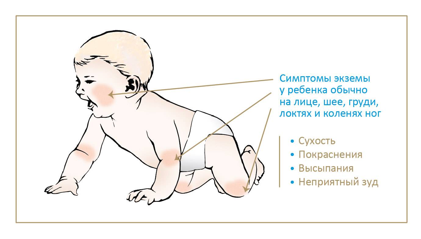 Аллергия на молоко у ребенка: симптомы, фото непереносимости белка у грудничка