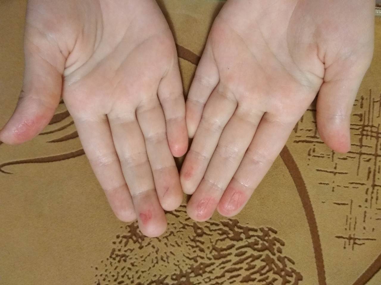 Кожа шелушится на подушечках пальцев рук. как лечить шелушение рук у детей | школа красоты