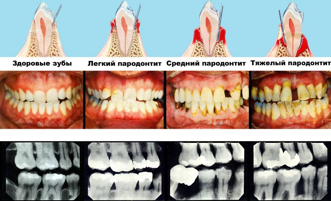 Лечебные зубные гели для десен взрослым при пародонтите и пародонтозе - лучшие заживляющие гели для десен при воспалении
