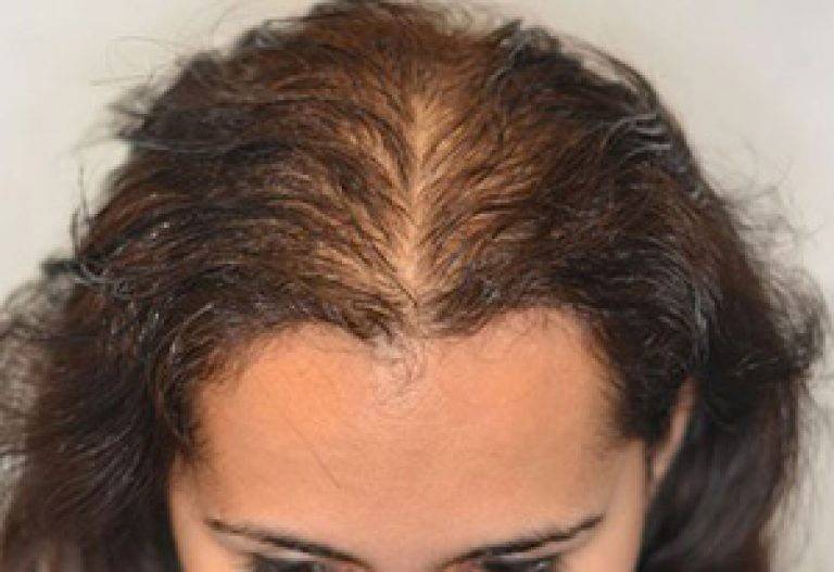 Восстановление волос после коронавируса