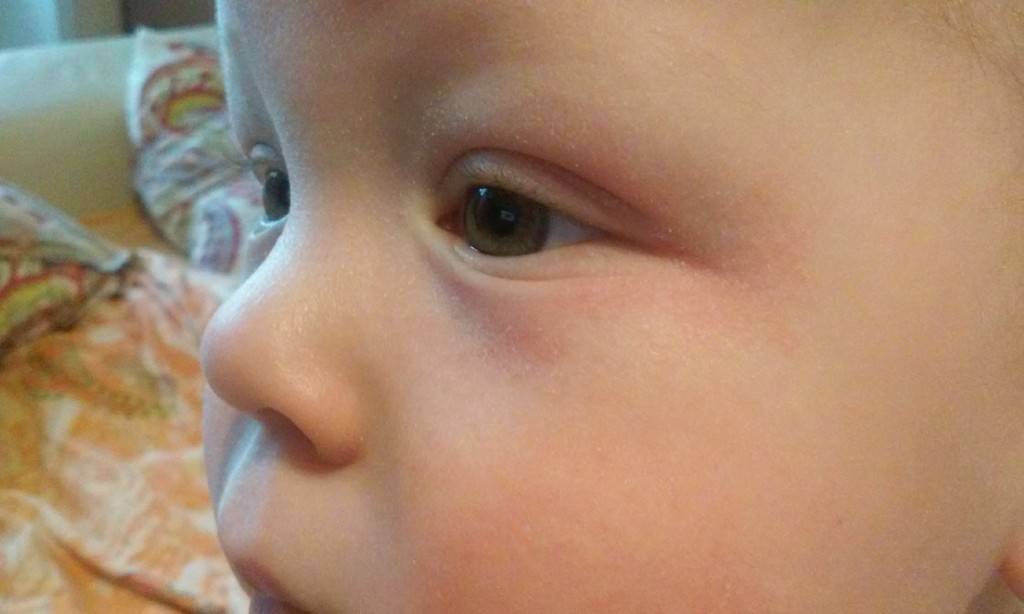 Блефарит у детей - виды и причины, диагностика и лечение | детская офтальмология см-клиники в спб