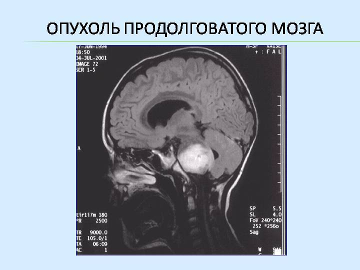 Рак мозга: симптомы, диагностика, лечение, стадии и профилактика опухоли головного мозга