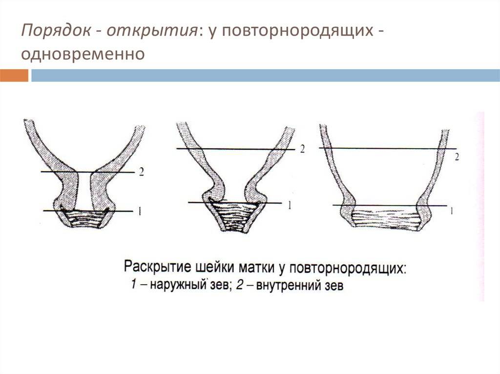 Деформация шейки матки (послеродовые разрывы шейки матки)