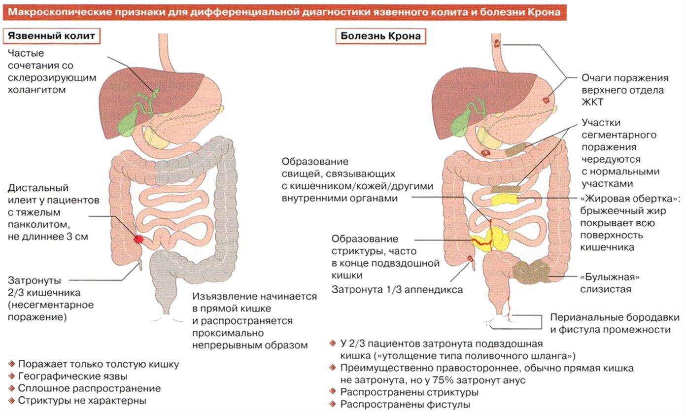 Неспецифический язвенный колит патогенез