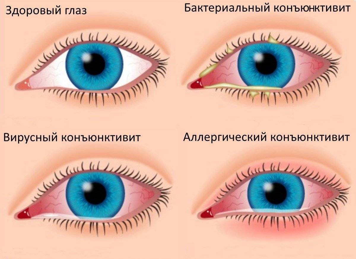 Глазные заболевания