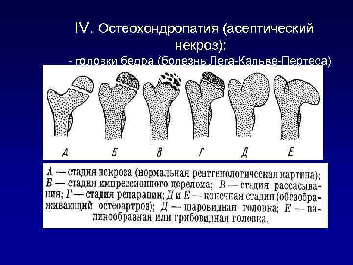 Болезнь легга-кальве-пертеса (остеохондропатия головки бедренной кости)   - medside.ru