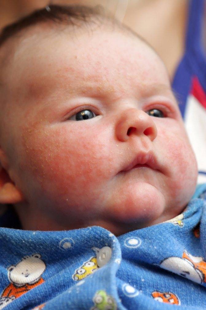 Пищевая аллергия у ребенка до года: симптомы, лечение | nutrilak