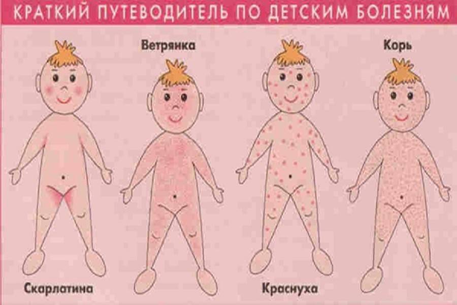 Как проявляется розеола у детей