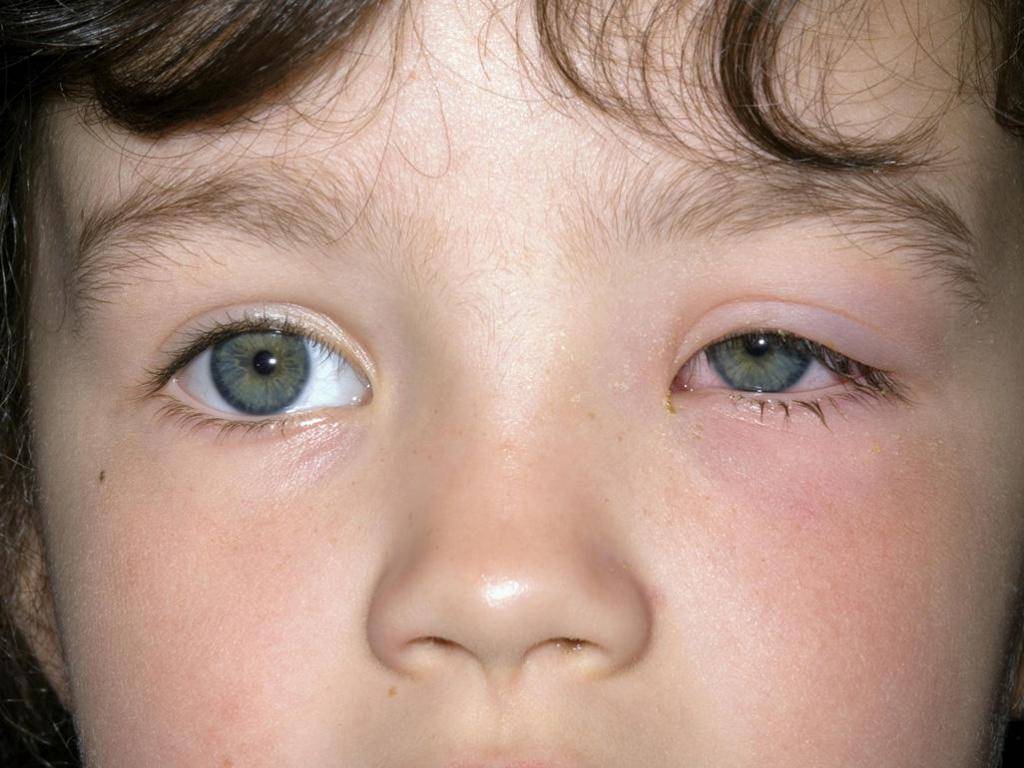 Аллергический конъюнктивит у детей - фото, лечение, причины и симптомы