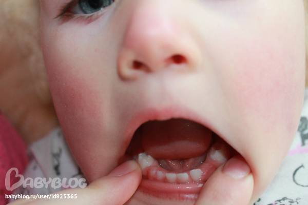 Что делать, если ребенок ударился челюстью, зуб потемнел и на десне образовалась гематома?