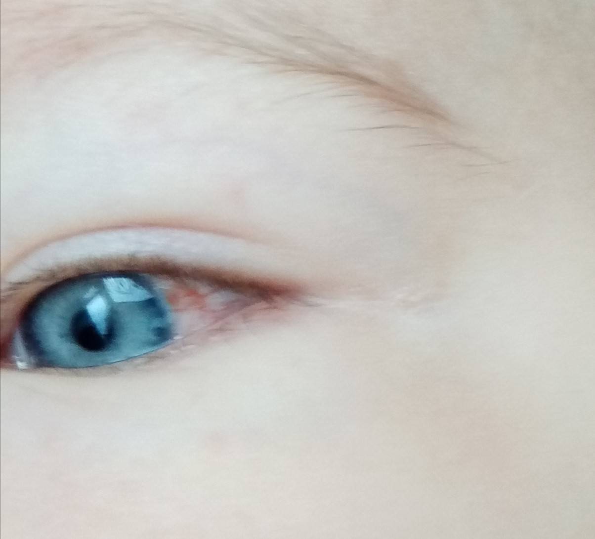 Покраснение глаз  – почему краснеют и болят глаза