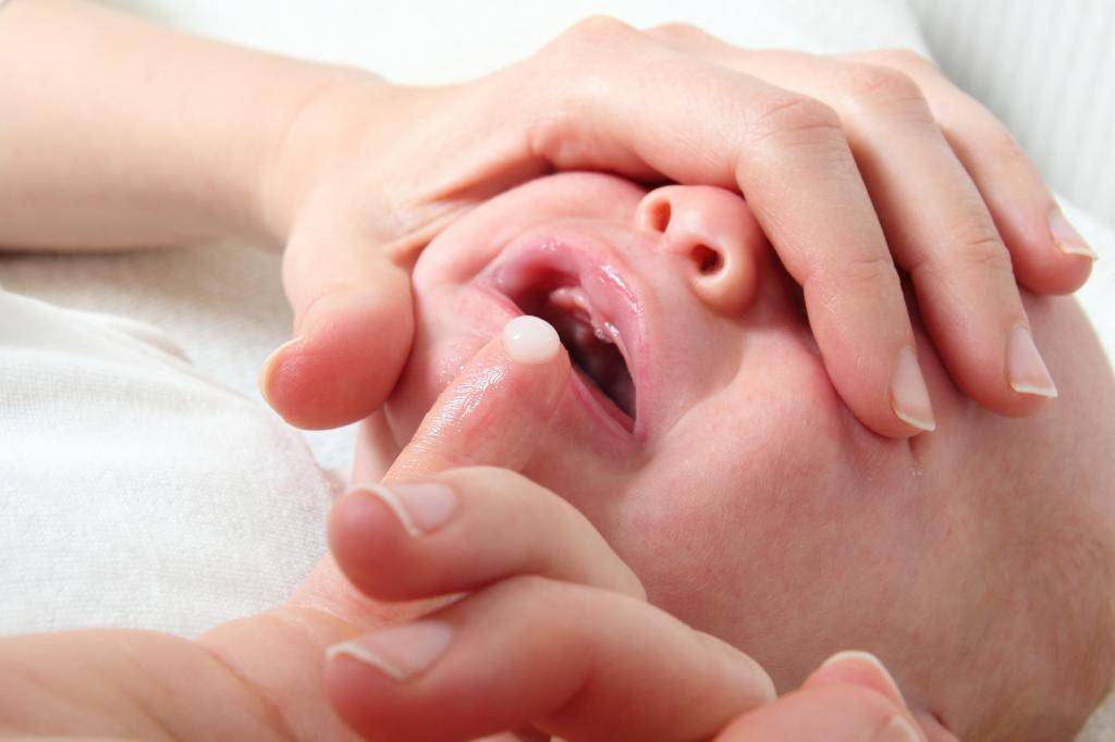 Кандидоз полости рта (стоматит) у детей: симптомы, причины, лечение