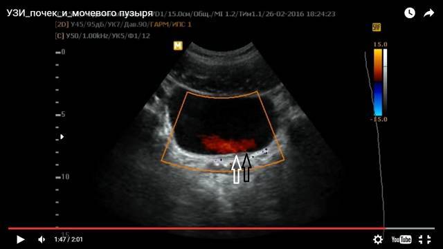 Как делают узи почек и мочевого пузыря у женщин фото