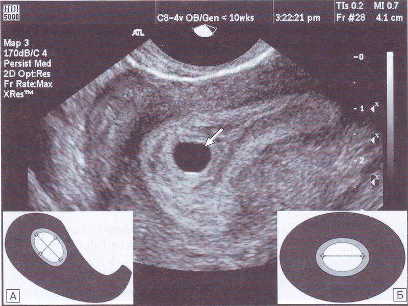 На узи не видно эмбриона. причины и что делать?