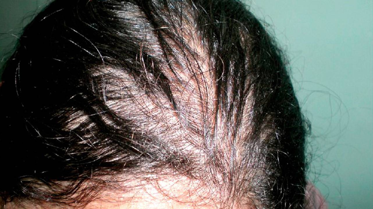 Гемоглобин волосы выпадают. Выпадение волос алопеция.