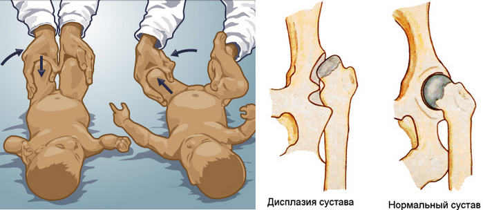 Дисплазия тбс у детей