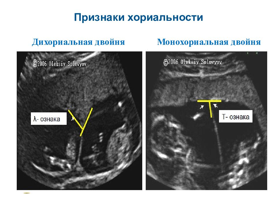 Многоплодная беременность: признаки, на ранних сроках по неделям, причины, осложнения