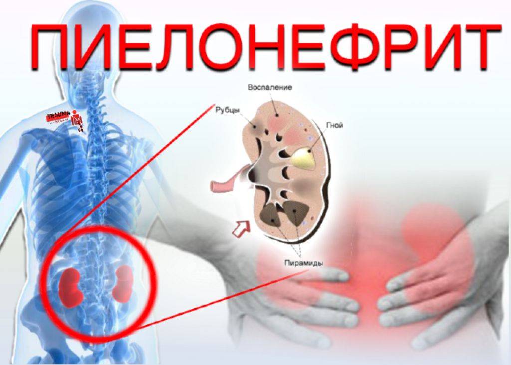 Пиелонефрит - симптомы, диагностика и лечение в нии им. н.а. лопаткина