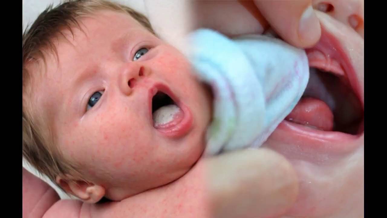 Молочница у детей во рту. как выглядит и чем лечить