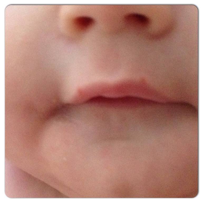 Герпес на губе у ребенка: чем лечить "простуду" грудничку и малышу от 1 года?
