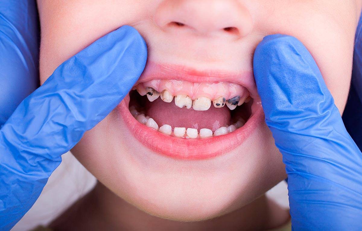Кариес молочных зубов - профилактика и лечение кариеса молочного зуба у ребенка