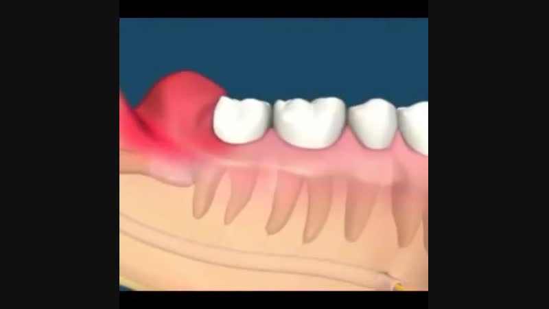 Травма зубов — детская челюстно-лицевая хирургия