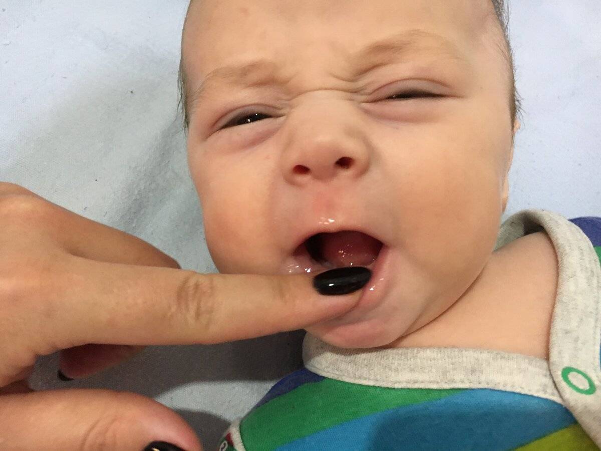 Ребенок ударился челюстью, зуб потемнел и на десне образовалась гематома: что делать?