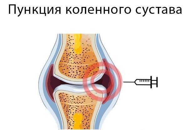 Боль в колене (коленном суставе)