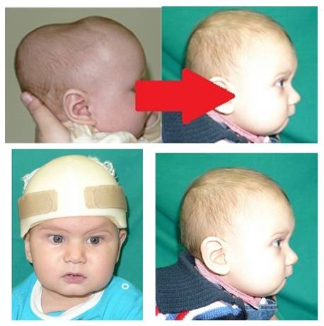 Преждевременное закрытие черепных швов у детей