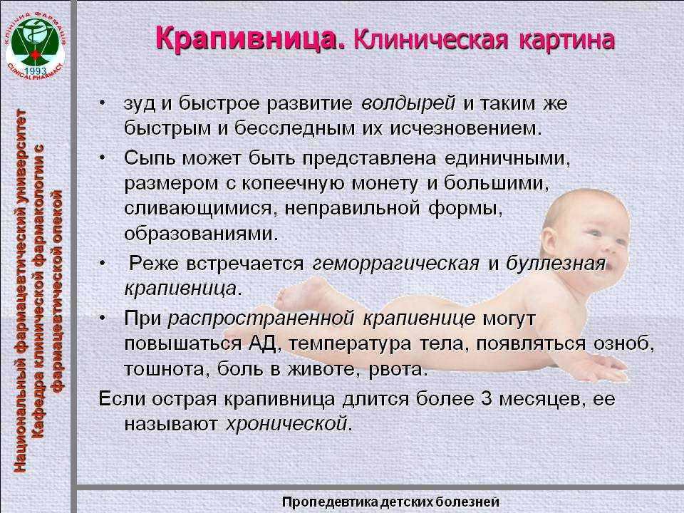 Крапивница у детей: опасность, причины, симптомы, лечение