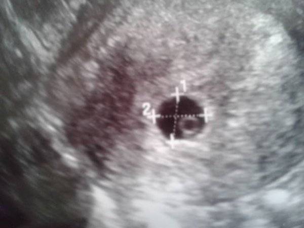Эмбрион четко не визуализируется или не лоцируется: что это значит, почему на 5–6 неделе беременности не виден зародыш?