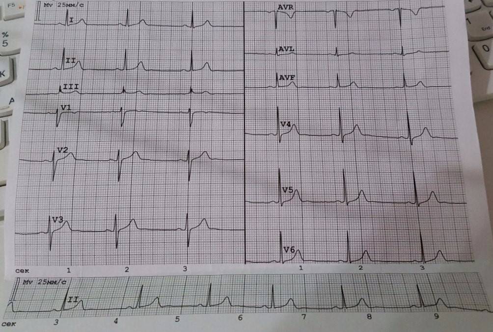 Внутрижелудочковая проводимость на экг что это. Нарушение внутрижелудочковой проводимости на ЭКГ. ЭКГ желудочковая брадикардия на ЭКГ. Нарушения желудочковой проводимости на ЭКГ. Желудочковая блокада на ЭКГ.