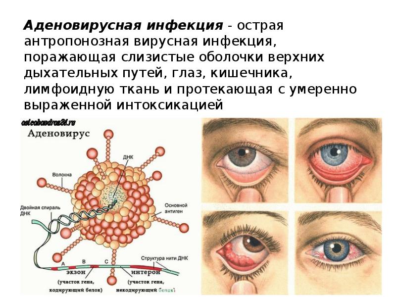 Аденовирусная инфекция у детей - как передается, симптомы,лечение