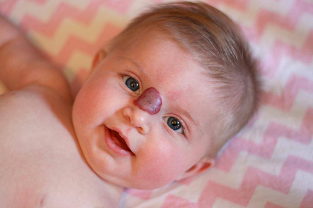 Всё о гемангиомах у новорожденных детей