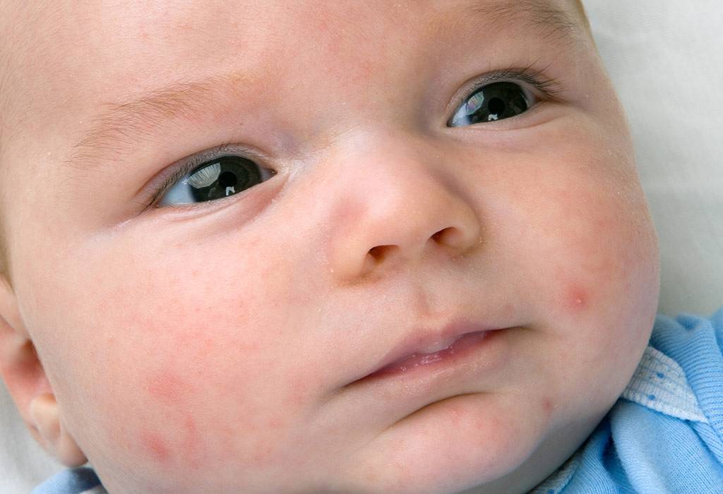 Кожная аллергия - причины, лечение аллергии на коже у детей и взрослых